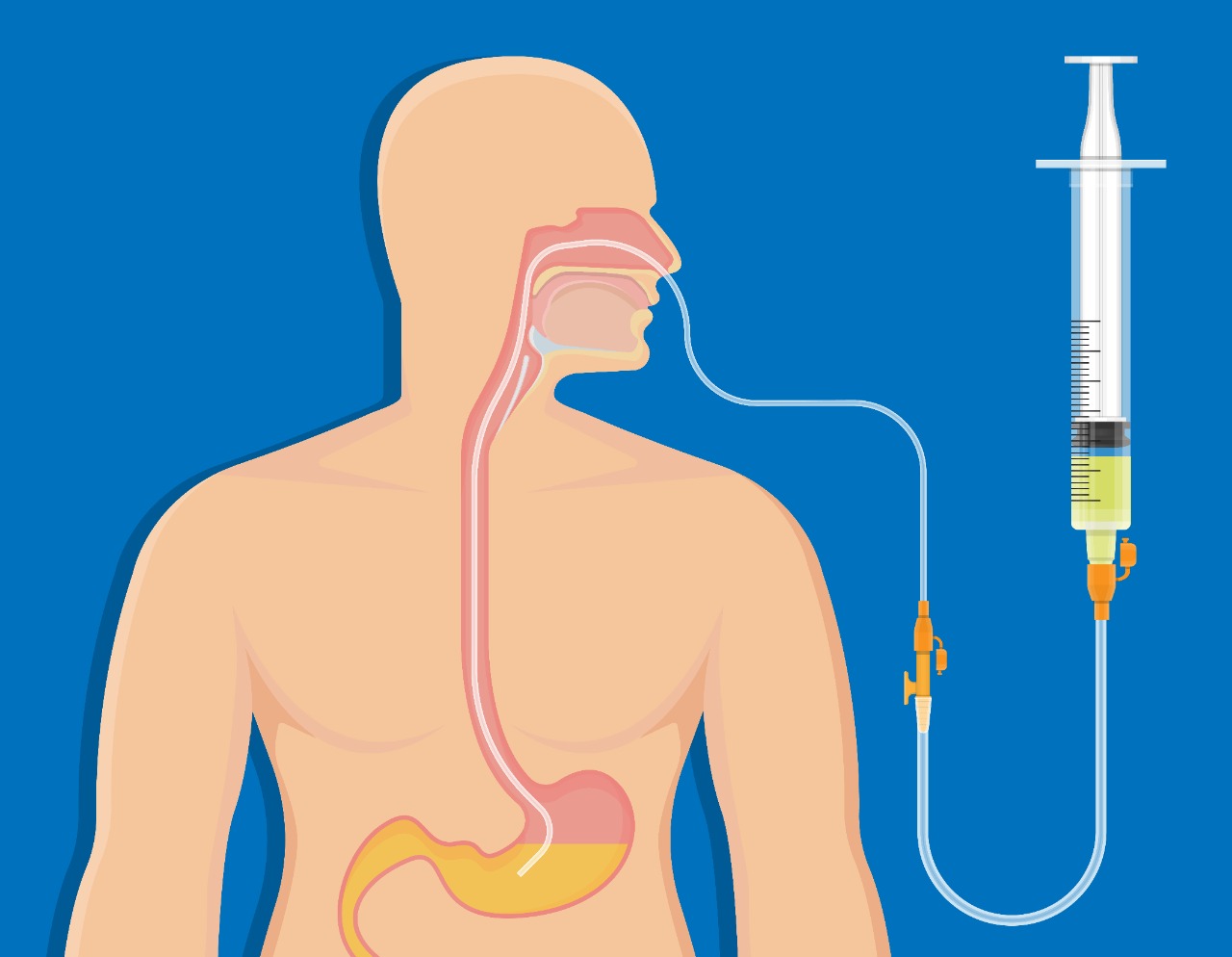 Gastrostomi Endoskopi Perkutan?