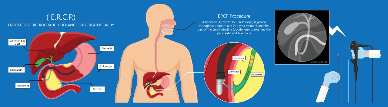 Endoscopic Retrograde Cholangiopancreatography