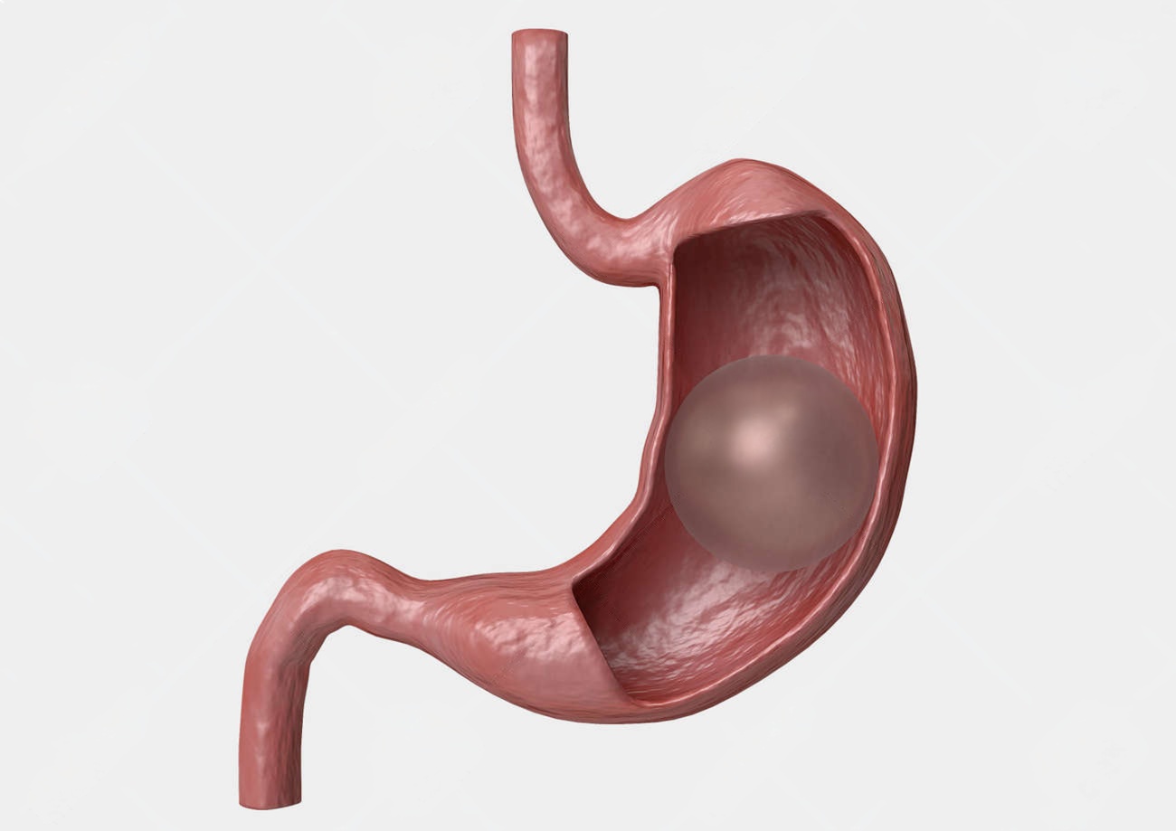 Prosedur Gastric Balloon