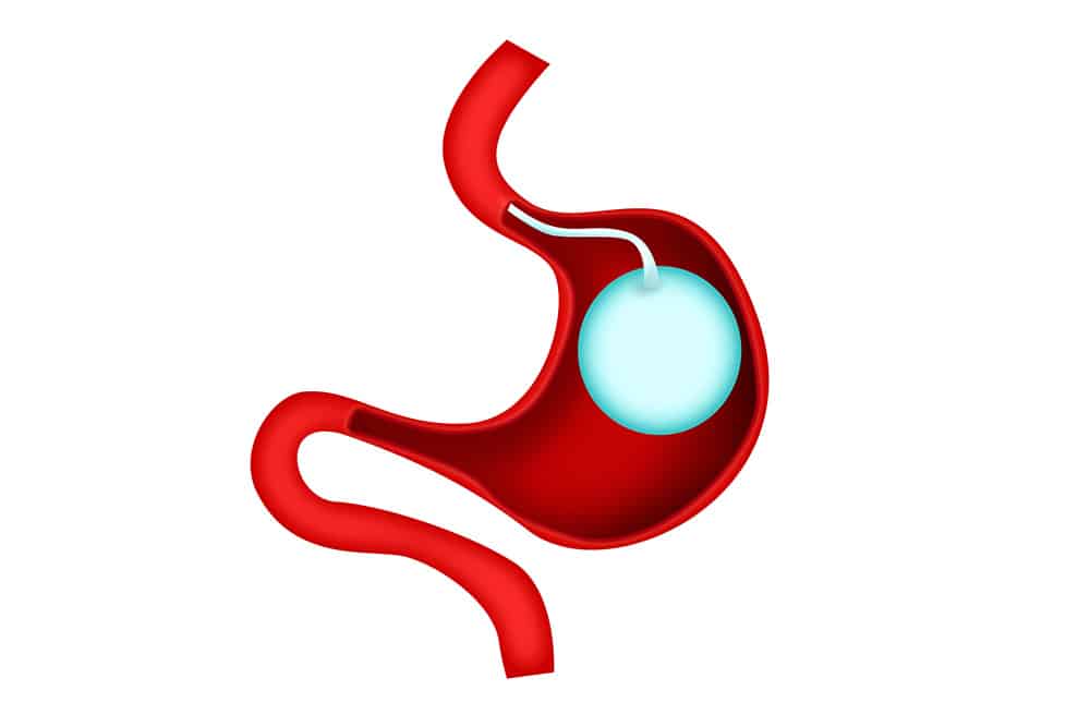 Gastric Balloon