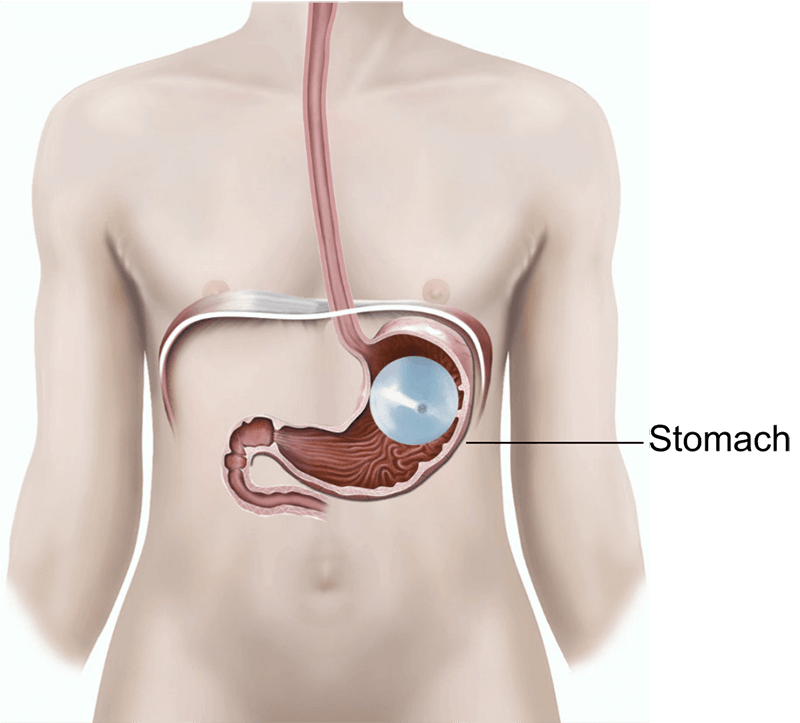 gastric balloon
