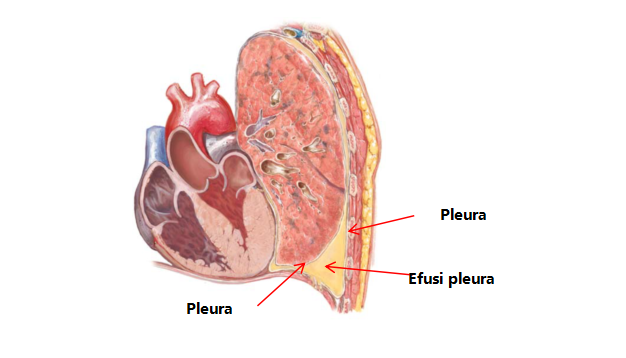 efusi pleura