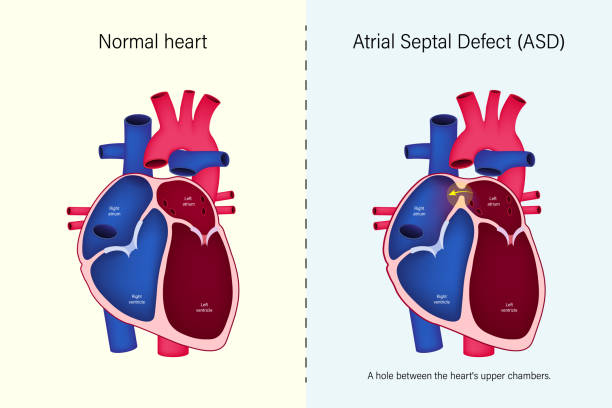 atrial septal defect