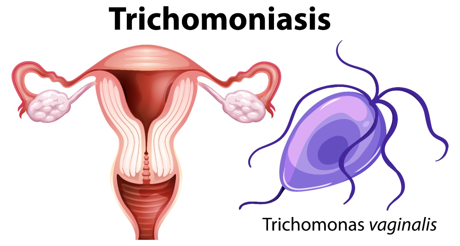 trikomoniasis