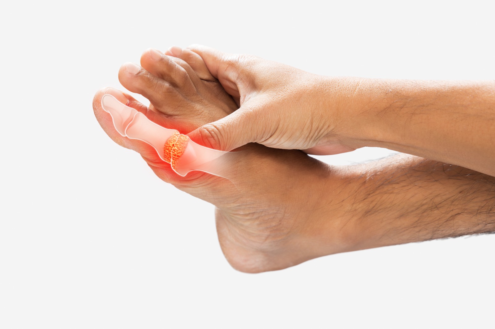 artritis gout