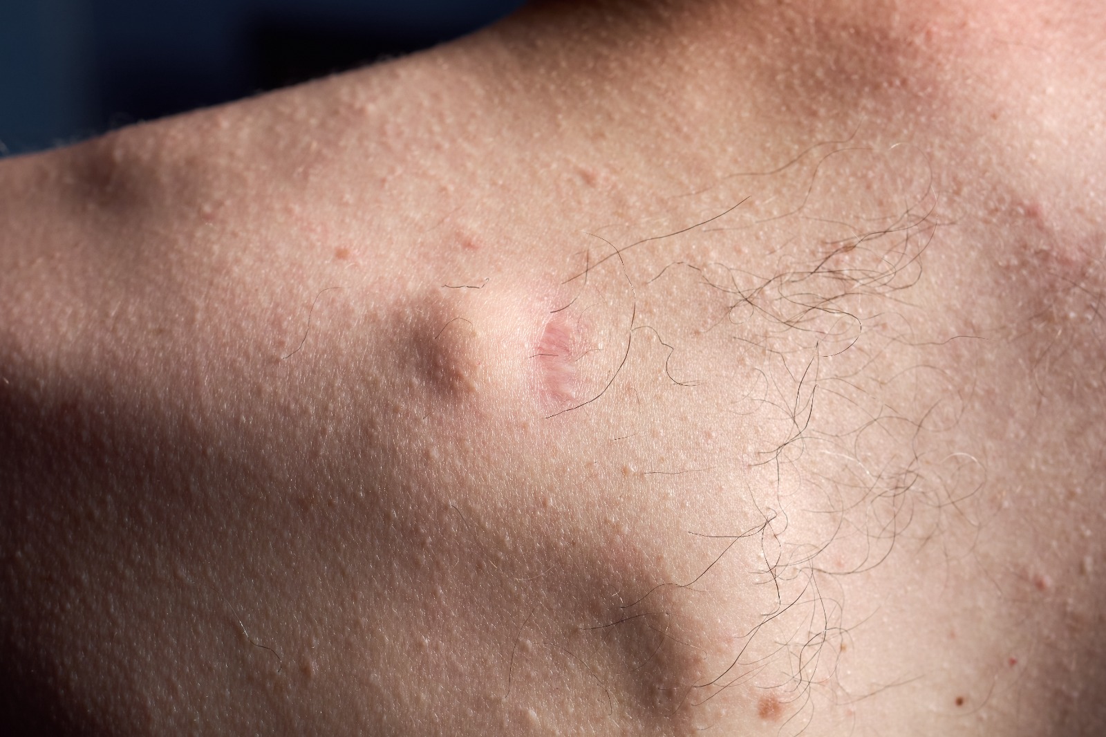 lipoma
