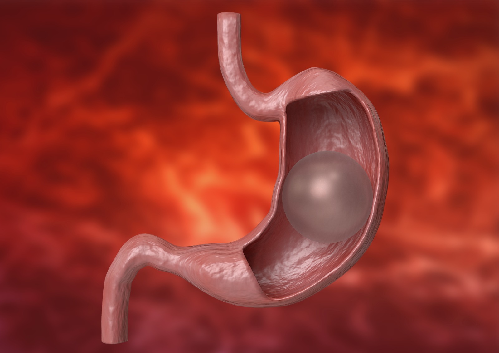 intragastric balloon